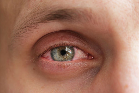 An image of a dry red eye